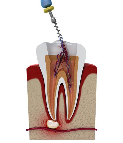 Root Canal Treatment