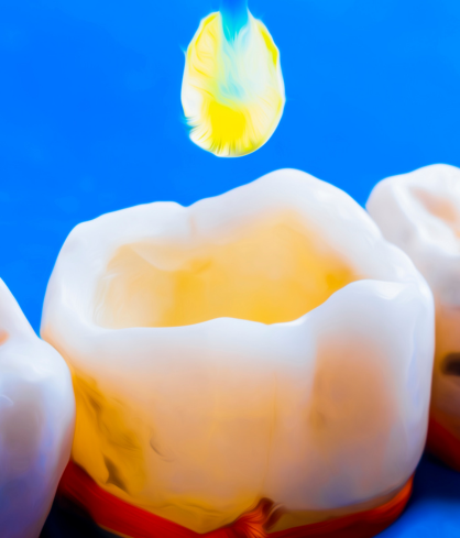 Tooth-Colored Fillings