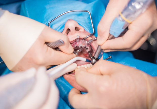 Types of Tooth Extractions: