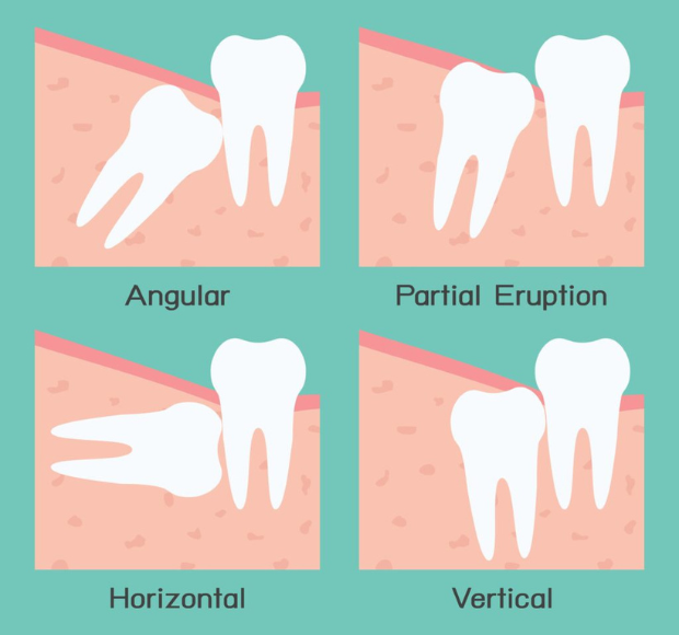 Types of Wisdom Tooth Impactions: