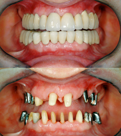 Full Mouth Rehabilitation