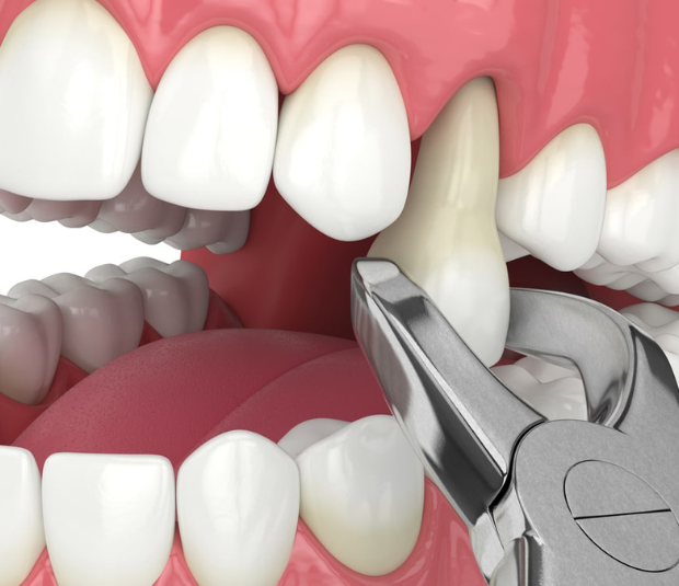 When is Tooth Extraction Necessary