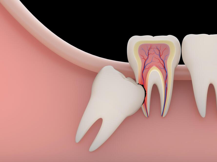 Wisdom Tooth Removal