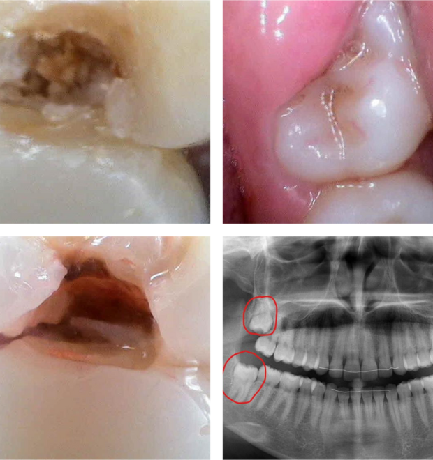 Wisdom Tooth Removal Needed