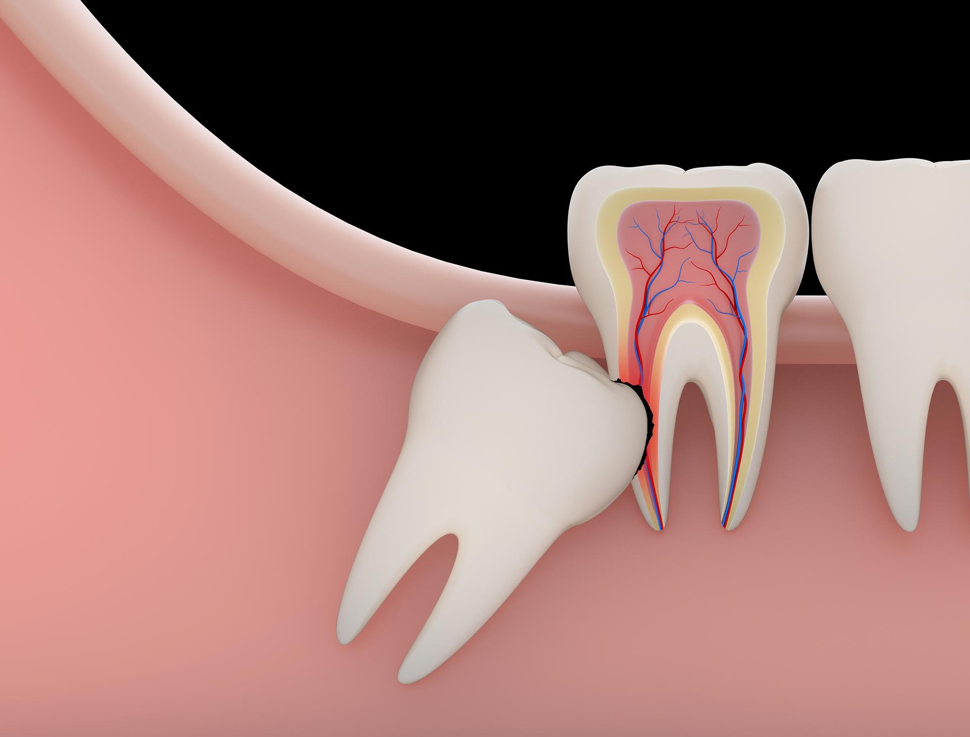 Wisdom Tooth Removal