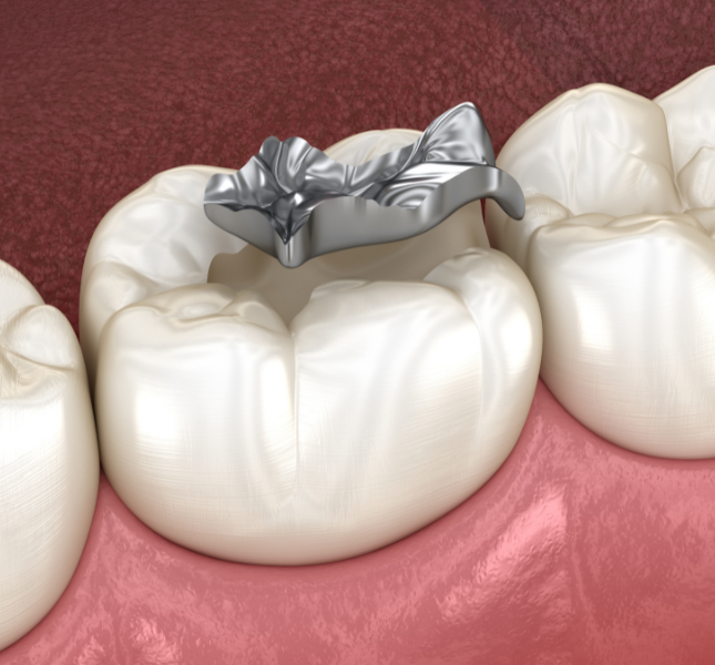composite-resin-fillings2