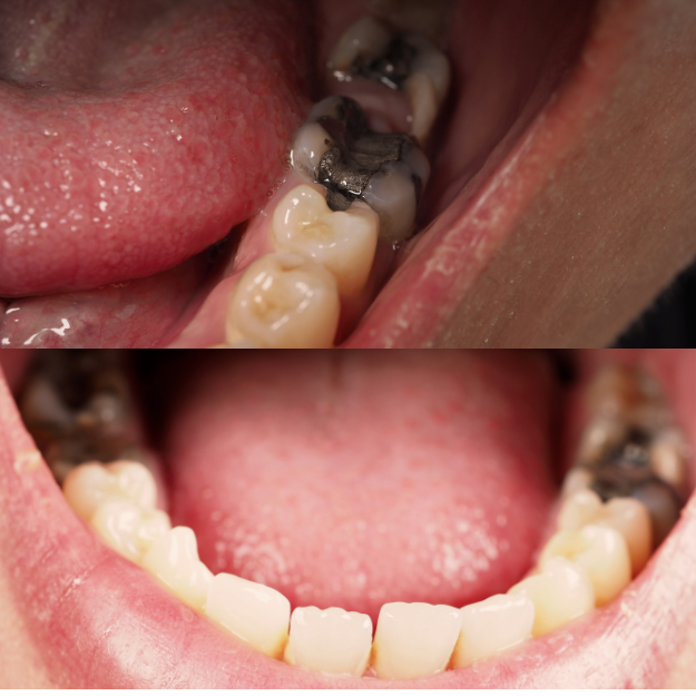 cavities & tooth decay Fluoride Treatment