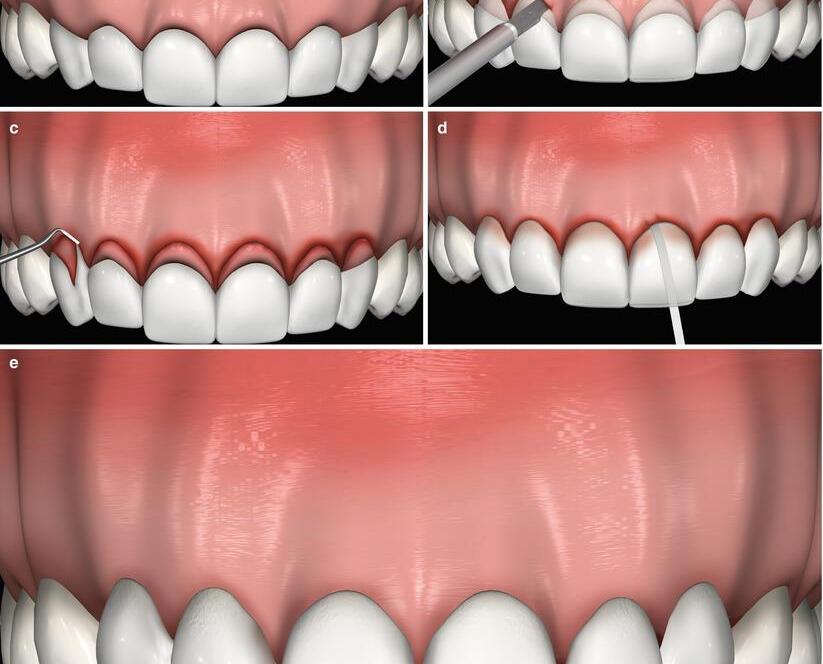 laser-gum-treatment02