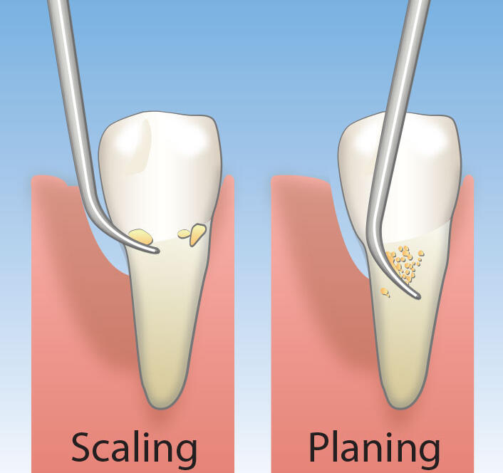 scaling-planing