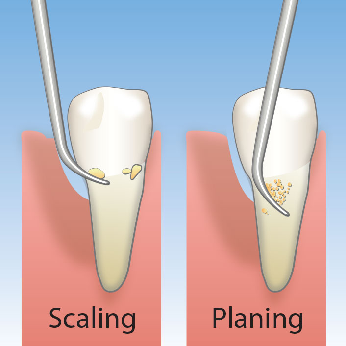 Scaling & Root Planing