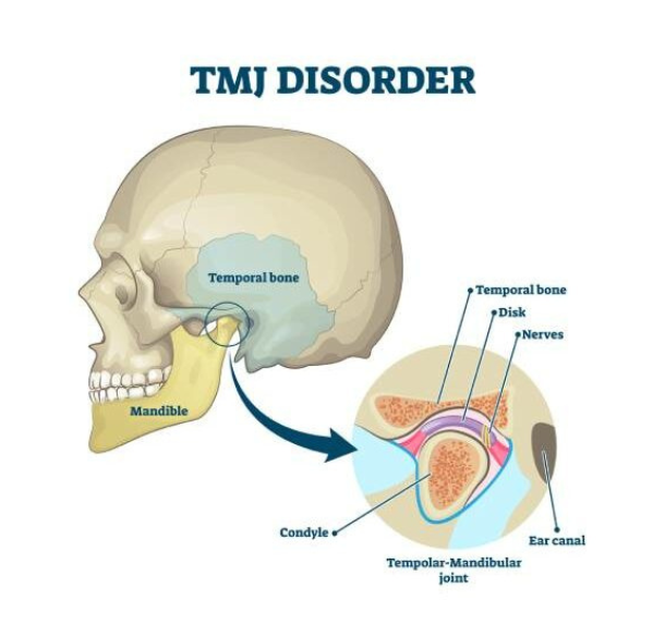 tmj-disorder (1)