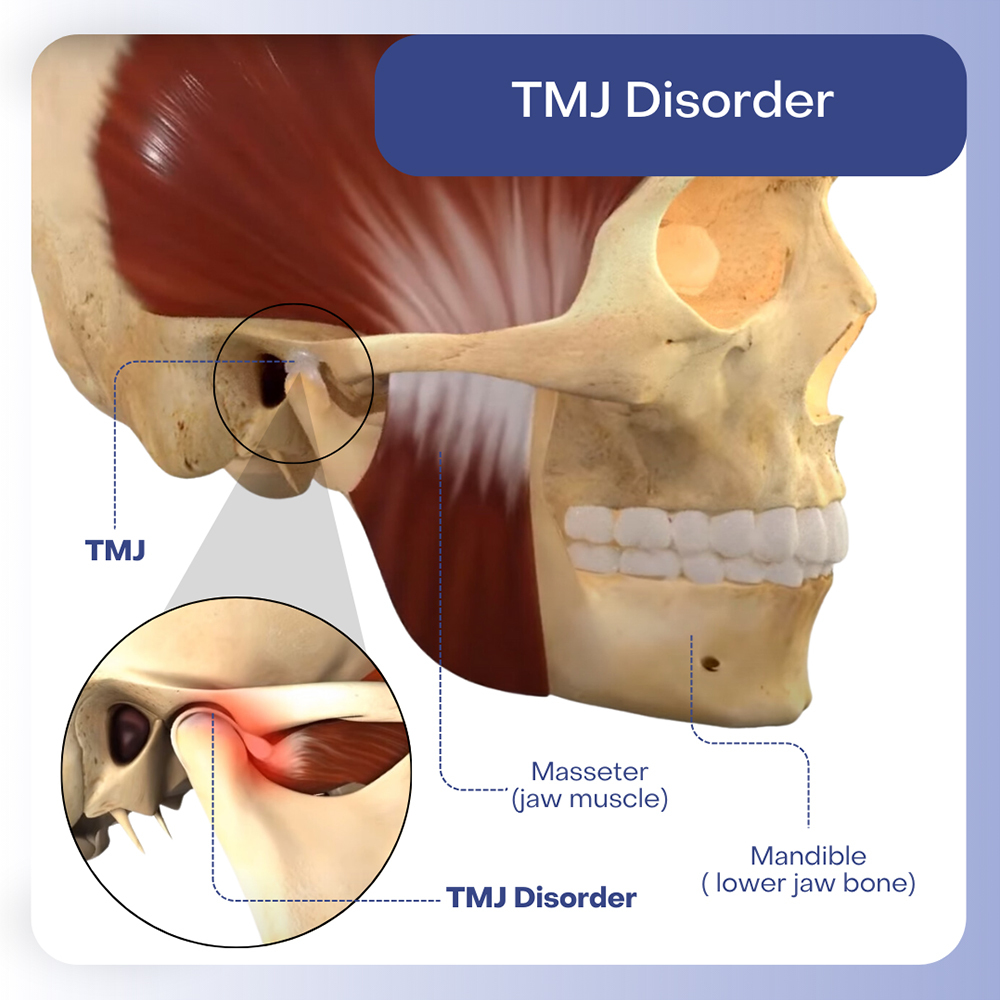 TMJ Disorder Treatment