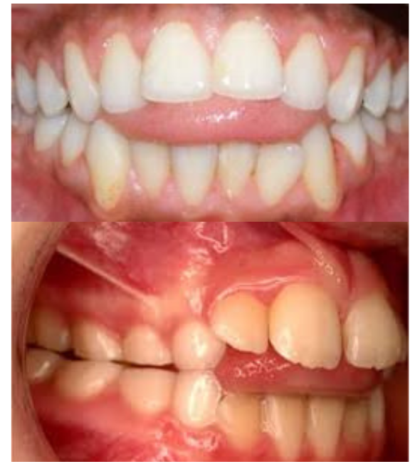 thumb-sucking, lip-biting, and tongue thrusting