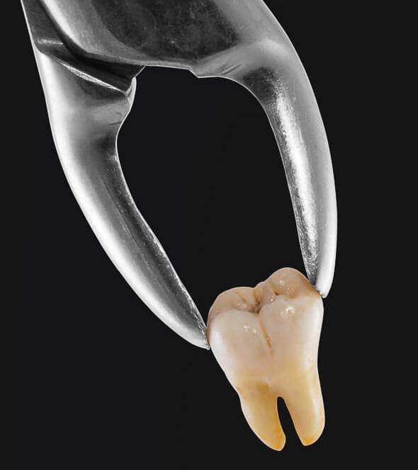 tooth-extraction